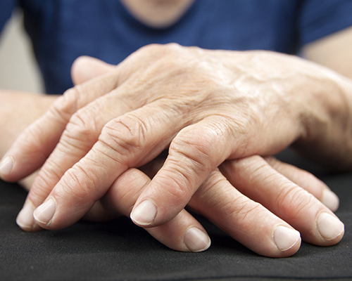 Hands with signs of arthritis resting on a table.