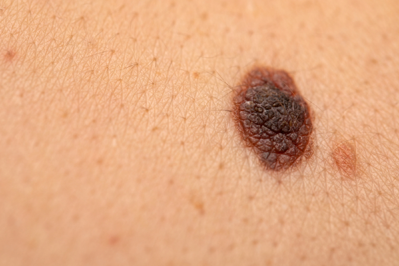 Example of a melanoma