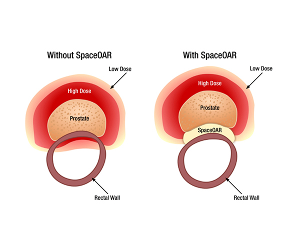 Diagram showing anatomy with or without SpaceOAR system